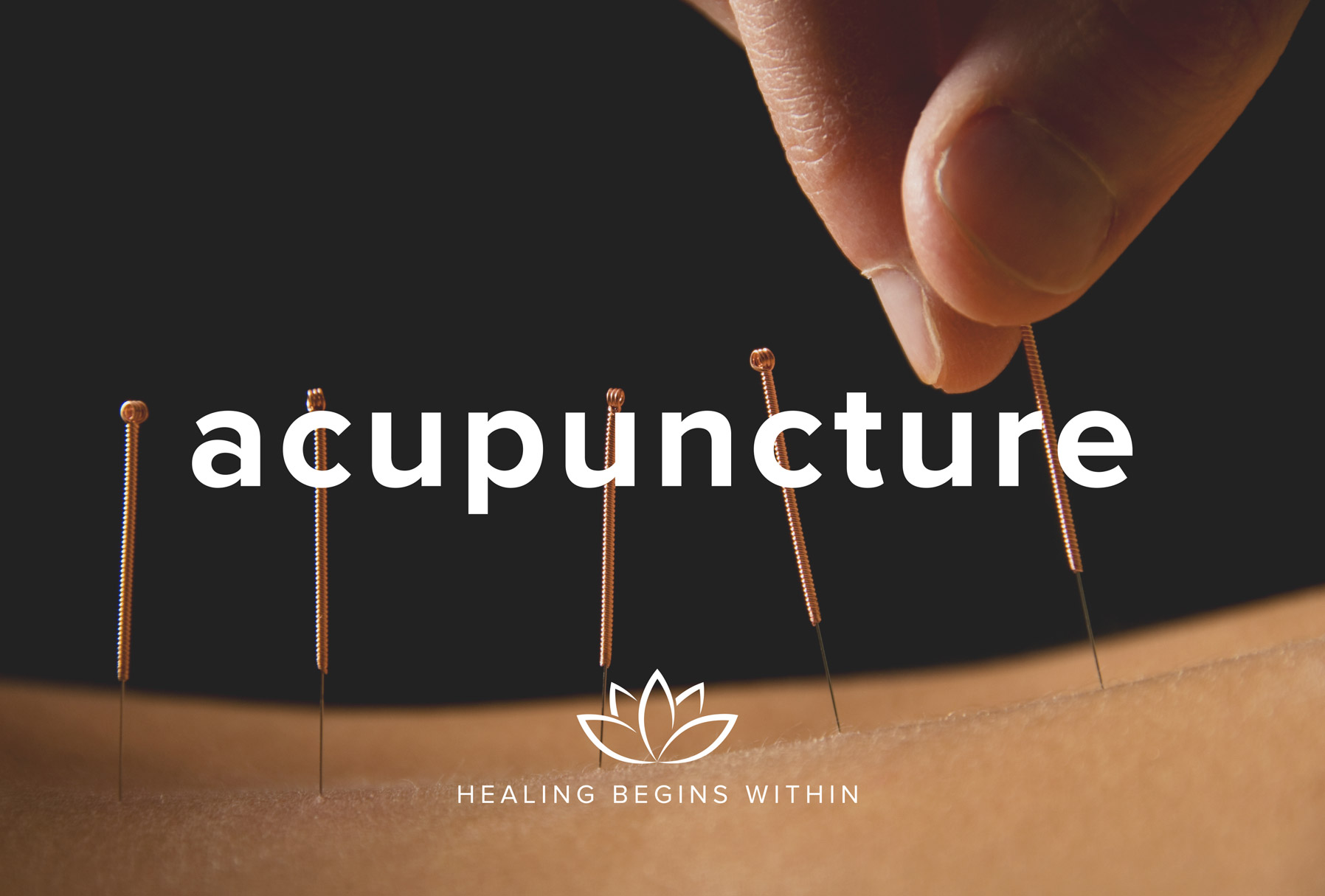 Self-Care at Smith: Acupuncture